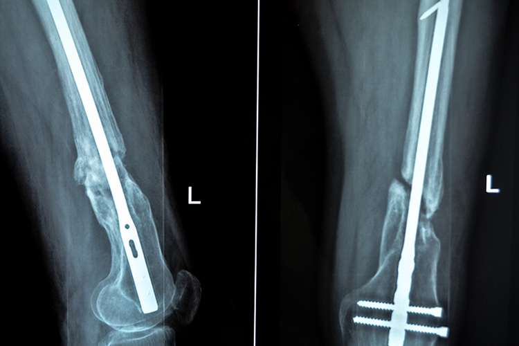 Именно поэтому выходом для него стал проект «Биотех-реабилитация раненых», клеточные технологии которого позволят быстро, без лишних осложнений вырастить перелом и восстановить естественную длину ноги